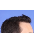 After Hair Transplant&nbsp;Front